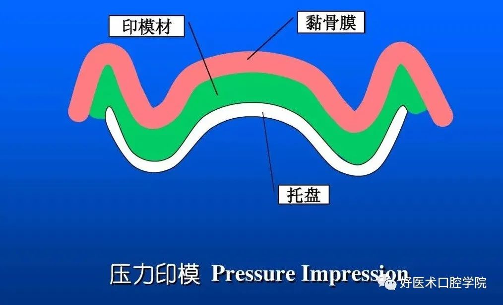 超清图解全口义齿印模制取方法，推荐收藏慢慢看！