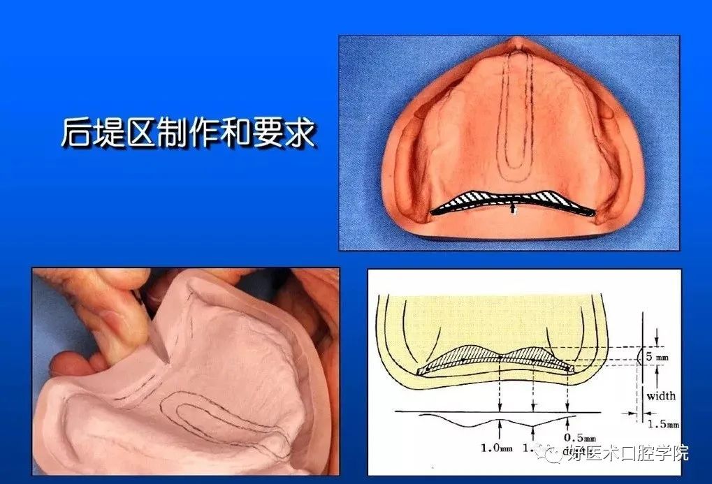 超清图解全口义齿印模制取方法，推荐收藏慢慢看！