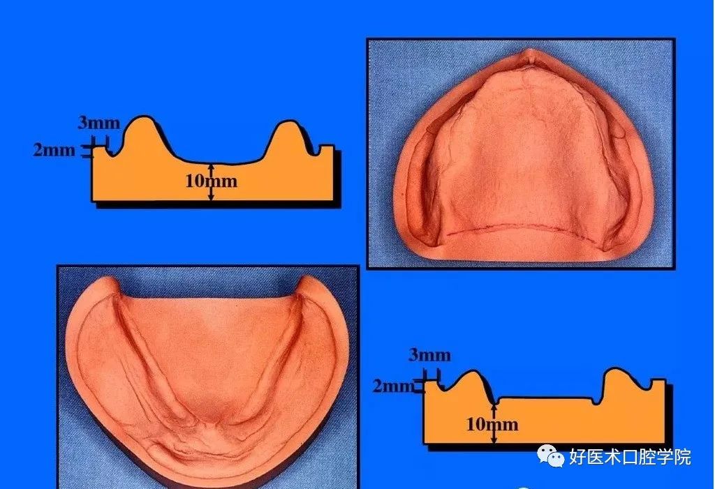 超清图解全口义齿印模制取方法，推荐收藏慢慢看！