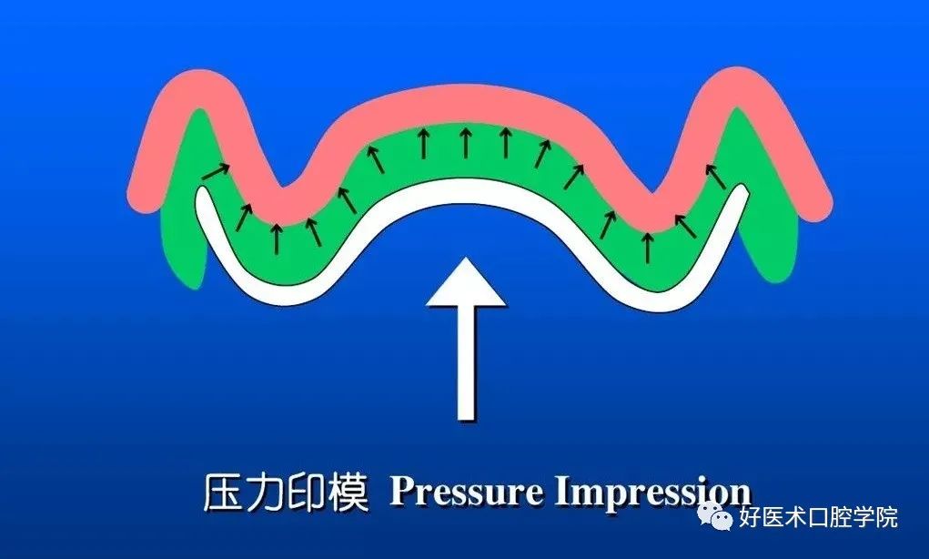 超清图解全口义齿印模制取方法，推荐收藏慢慢看！