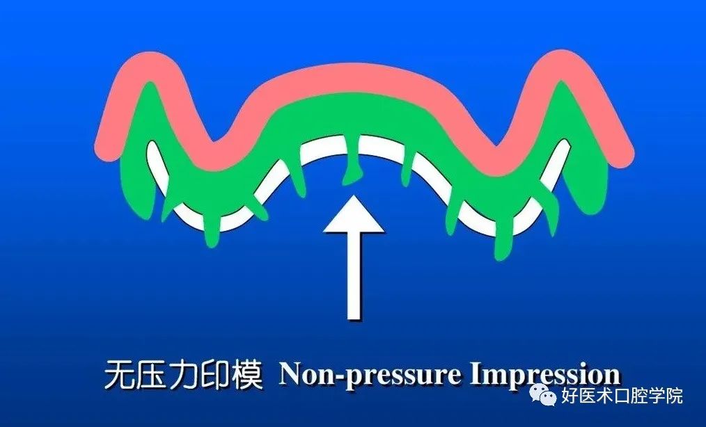 超清图解全口义齿印模制取方法，推荐收藏慢慢看！