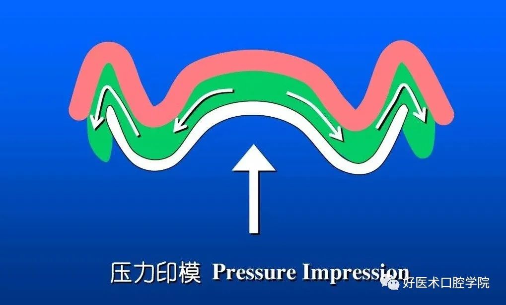 超清图解全口义齿印模制取方法，推荐收藏慢慢看！