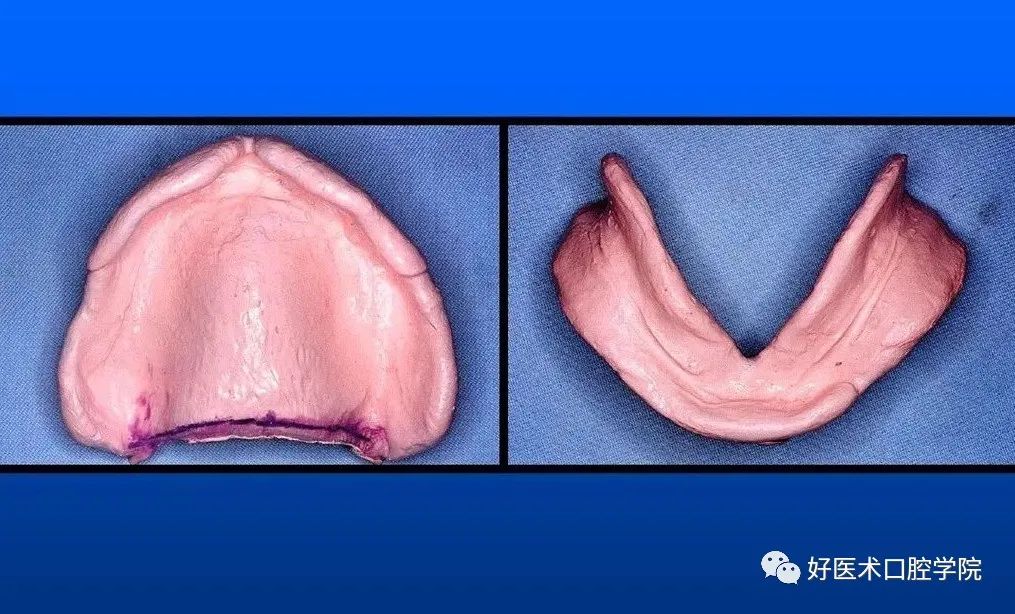 超清图解全口义齿印模制取方法，推荐收藏慢慢看！