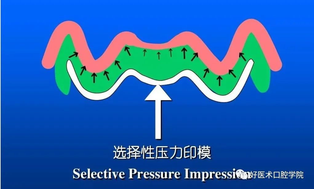 超清图解全口义齿印模制取方法，推荐收藏慢慢看！