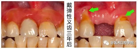 为什么我劝你不要随便做隐形义齿，答案就在这里！