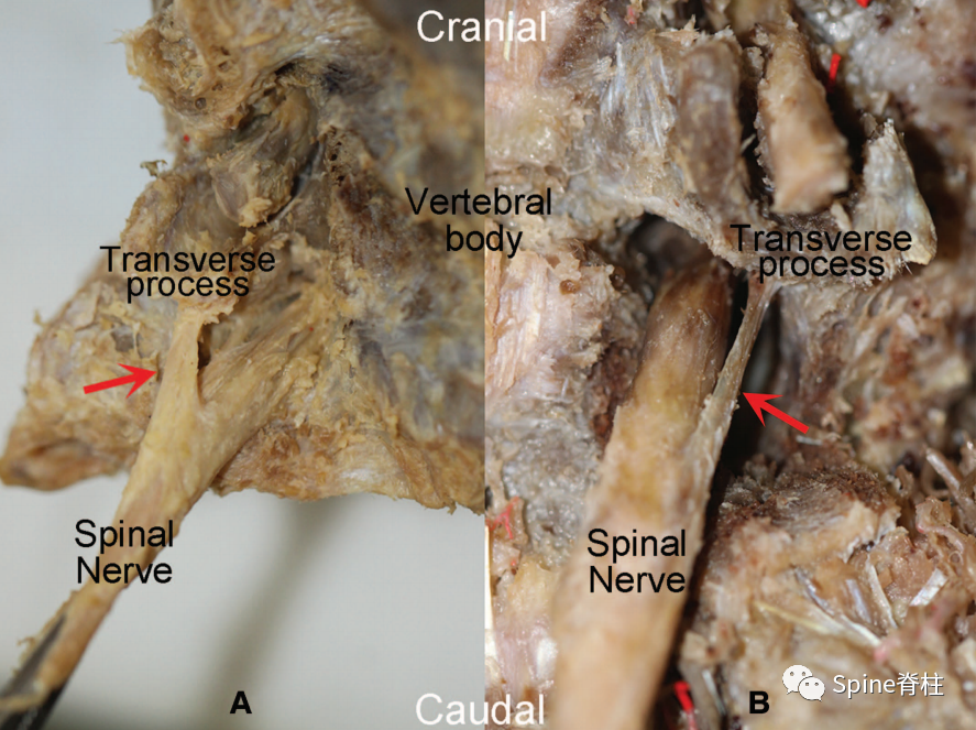 椎间孔内外韧带解剖及作用，详细解析推荐收藏！