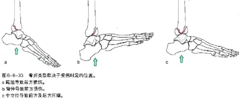 这些pilon骨折治疗知识，能获得更好效果！