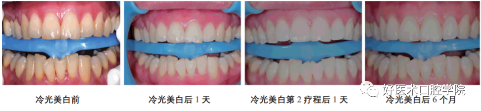 口腔科教你科学牙齿美白，用这招就够了！