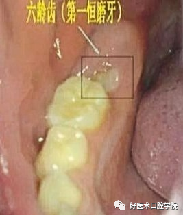 牙科医生给孩子的护牙秘籍，除了刷牙还多做了这一点！