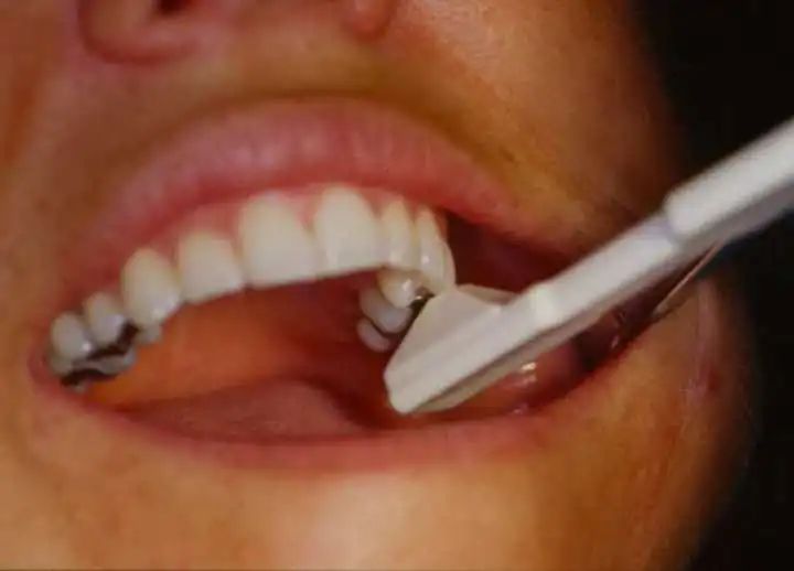 遇到这种情况，医生让你做牙套是真的在帮你！