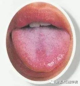 患者舌头有这种情况,口腔医生必须了解!