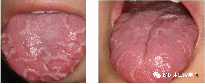 mm舌头口腔内图片
