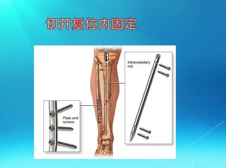 下肢骨关节损伤诊治全过程，图文解析更易懂！