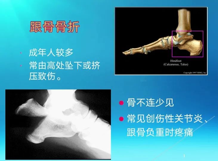 下肢骨关节损伤诊治全过程，图文解析更易懂！