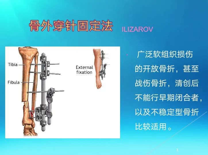 下肢骨关节损伤诊治全过程，图文解析更易懂！