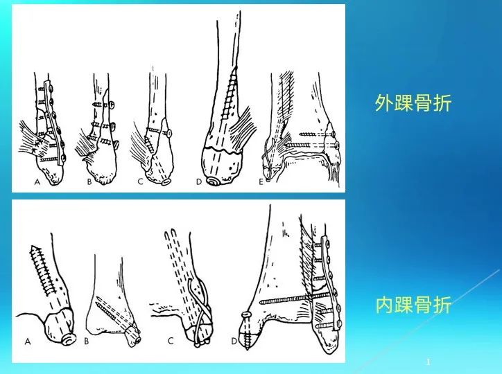 下肢骨关节损伤诊治全过程，图文解析更易懂！