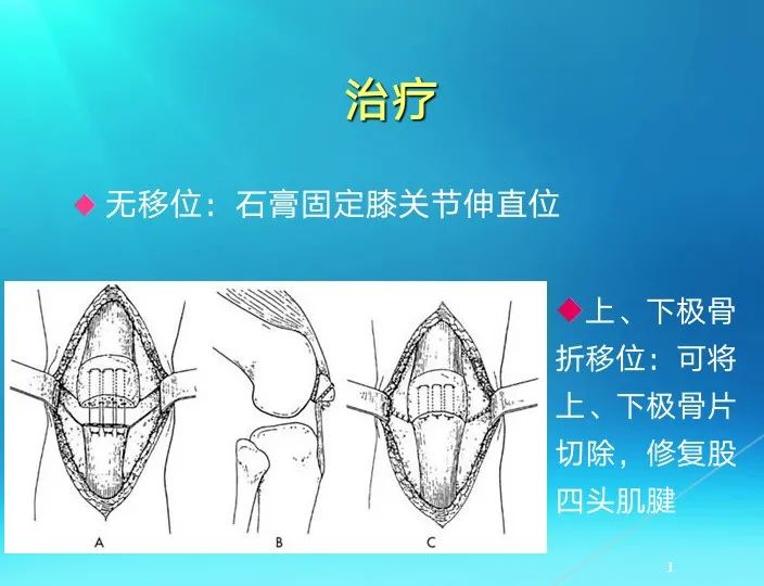 下肢骨关节损伤诊治全过程，图文解析更易懂！