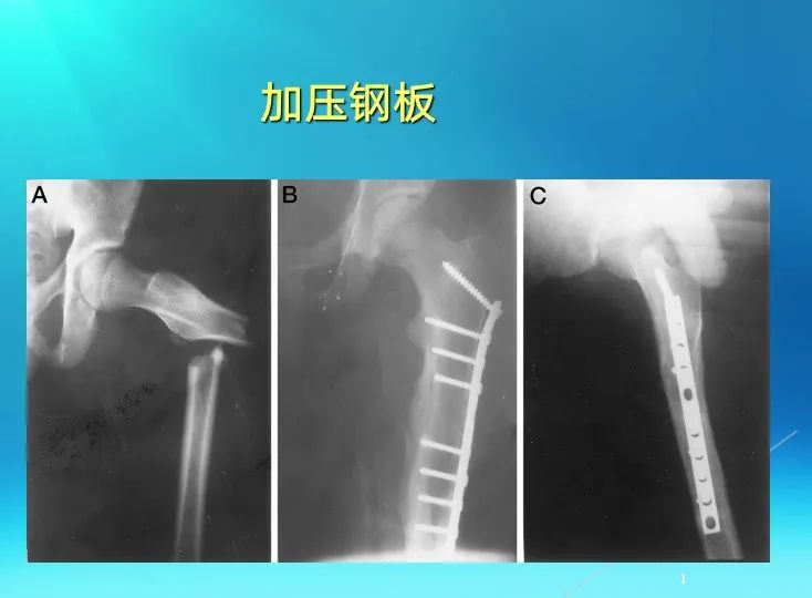 下肢骨关节损伤诊治全过程，图文解析更易懂！