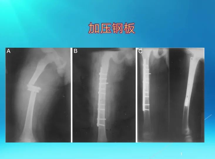 下肢骨关节损伤诊治全过程，图文解析更易懂！