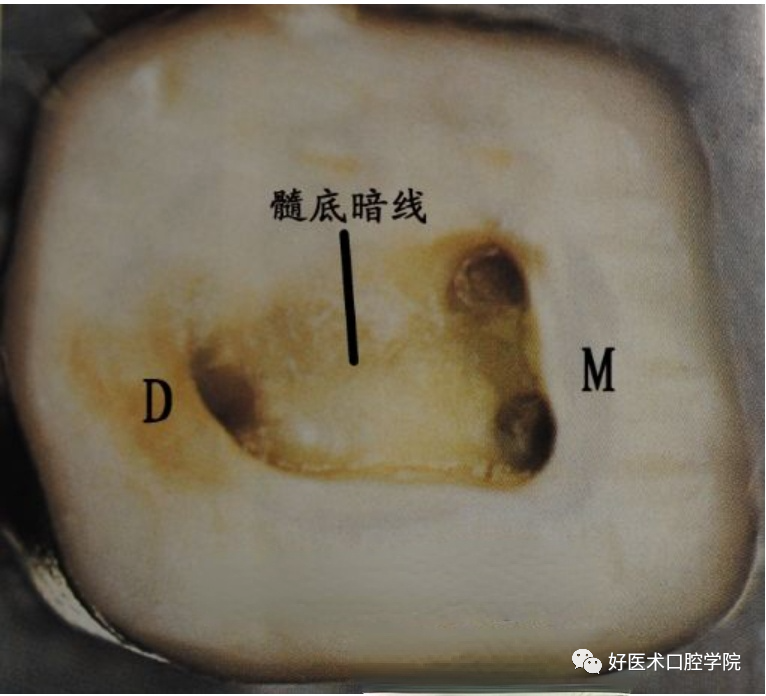 根管治疗的常见问题及解决方法，核心笔记必看！