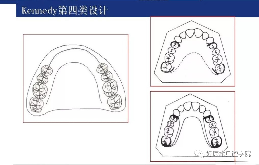 牙列缺损该如何设计修复，一文带你看懂！