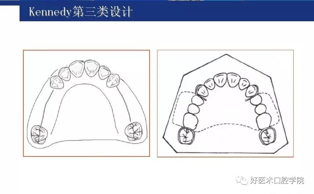 牙列缺损该如何设计修复，一文带你看懂！