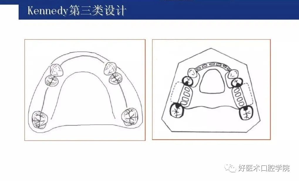 牙列缺损该如何设计修复，一文带你看懂！