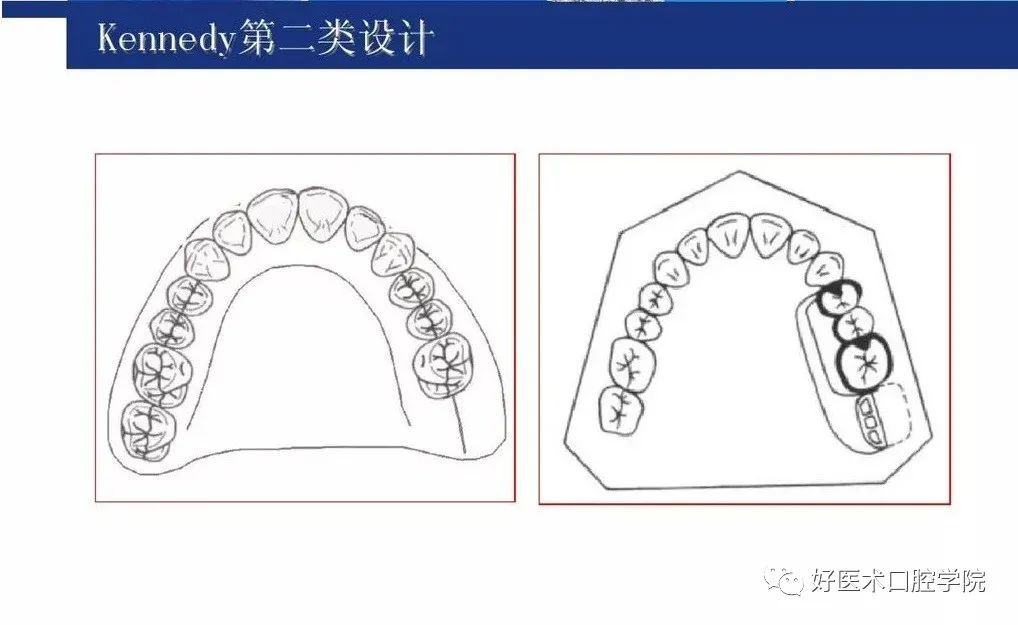 牙列缺损该如何设计修复，一文带你看懂！