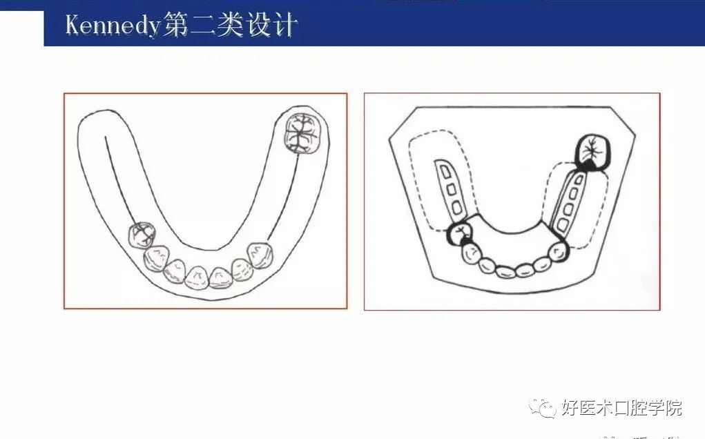 牙列缺损该如何设计修复，一文带你看懂！