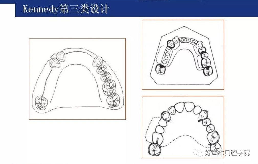 牙列缺损该如何设计修复，一文带你看懂！