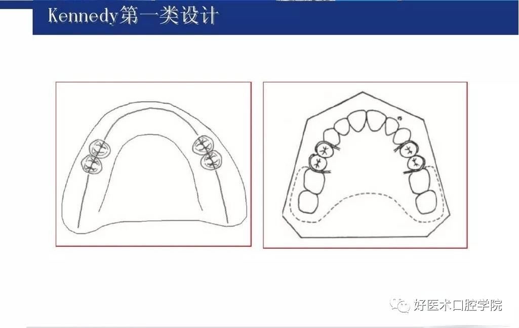 牙列缺损该如何设计修复，一文带你看懂！