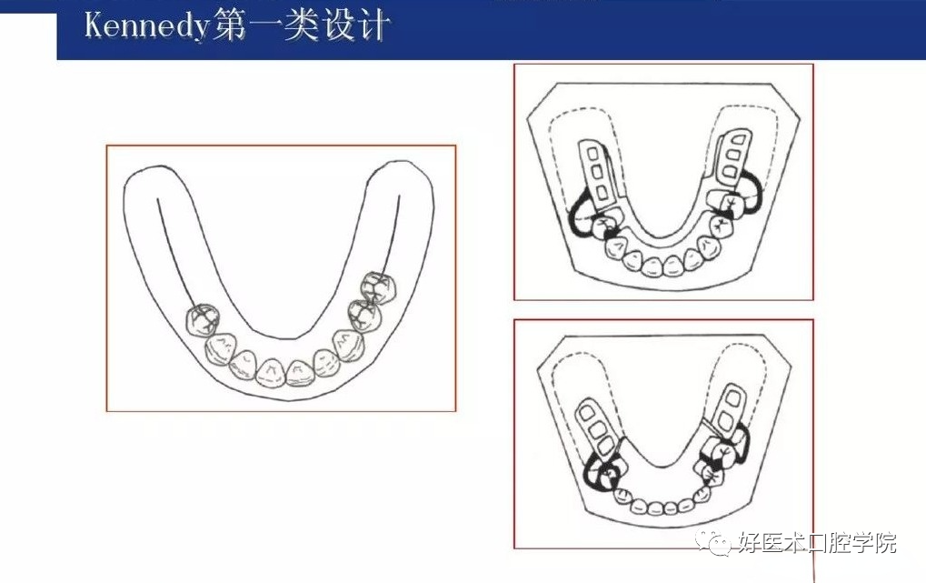 牙列缺损该如何设计修复，一文带你看懂！