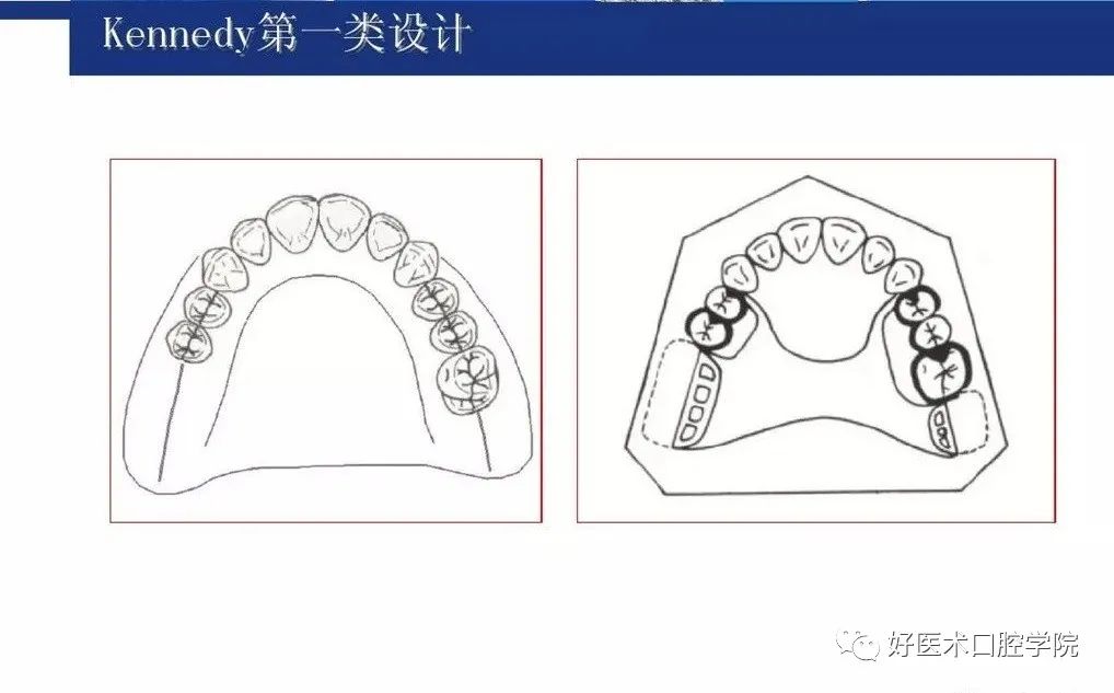 牙列缺损该如何设计修复，一文带你看懂！