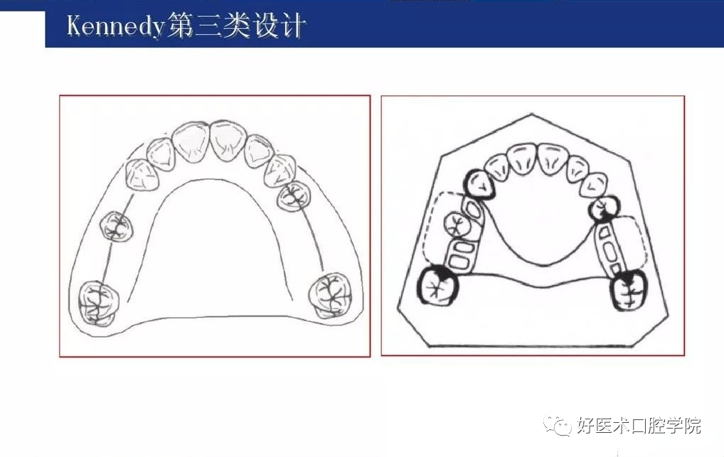 牙列缺损该如何设计修复，一文带你看懂！