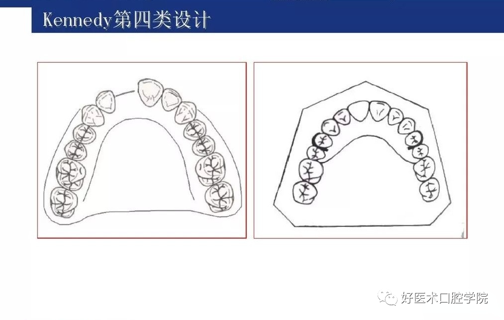 牙列缺损该如何设计修复，一文带你看懂！