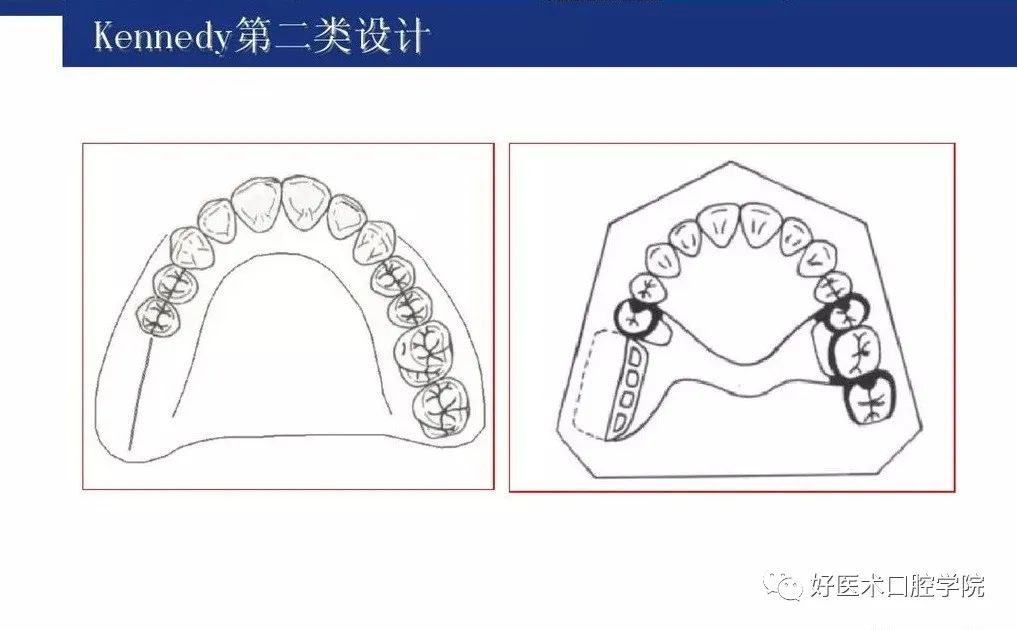 牙列缺损该如何设计修复，一文带你看懂！