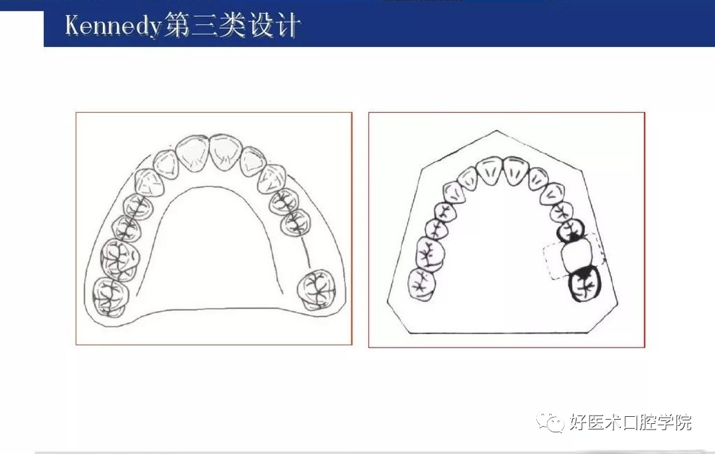 牙列缺损该如何设计修复，一文带你看懂！