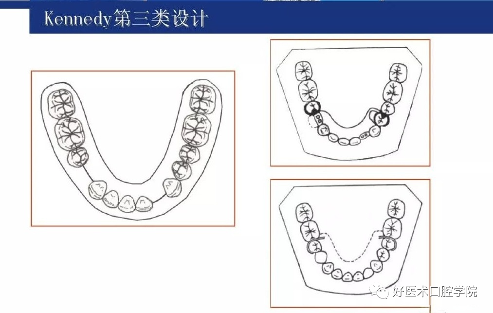 牙列缺损该如何设计修复，一文带你看懂！