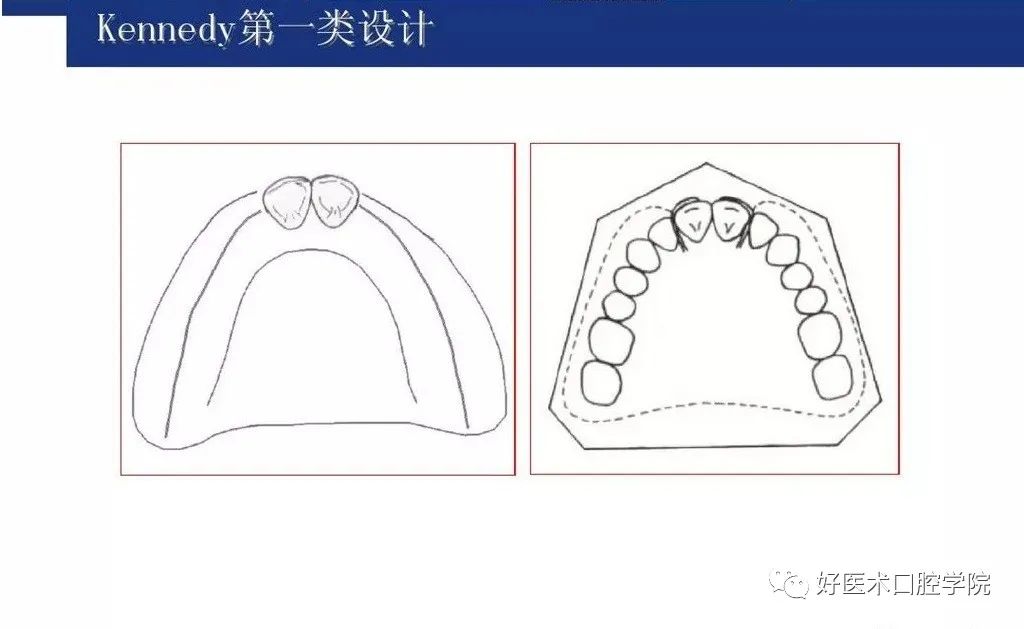 牙列缺损该如何设计修复，一文带你看懂！