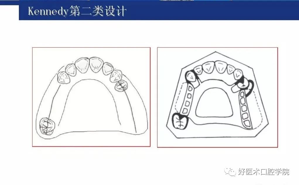 牙列缺损该如何设计修复，一文带你看懂！