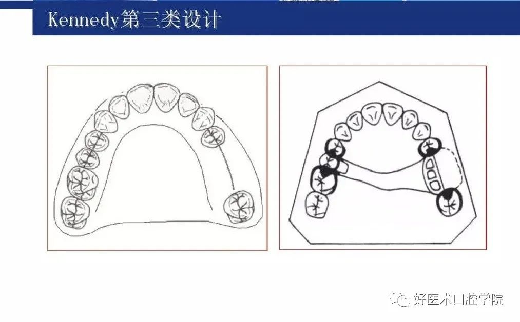 牙列缺损该如何设计修复，一文带你看懂！