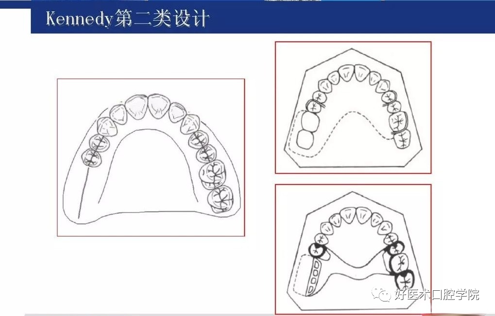 牙列缺损该如何设计修复，一文带你看懂！