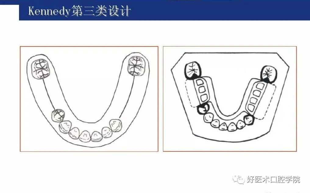 牙列缺损该如何设计修复，一文带你看懂！