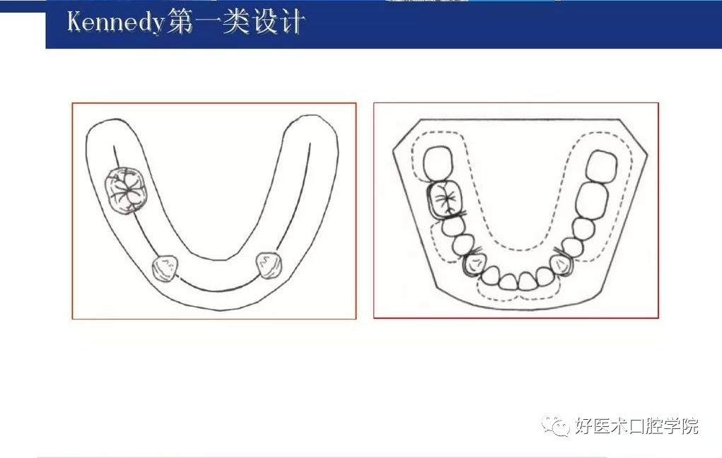 牙列缺损该如何设计修复，一文带你看懂！