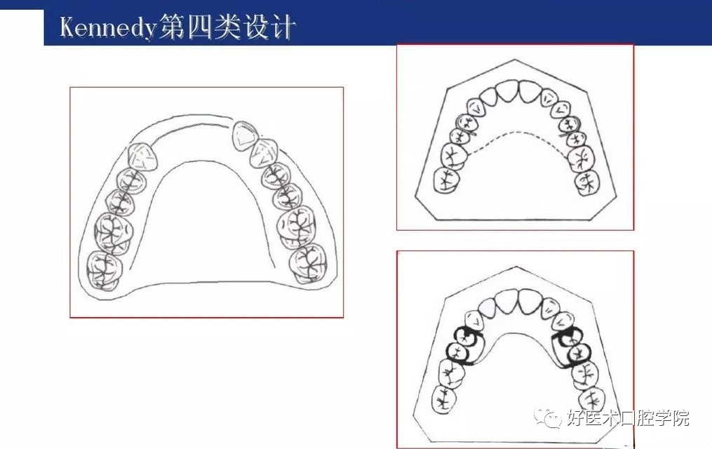 牙列缺损该如何设计修复，一文带你看懂！