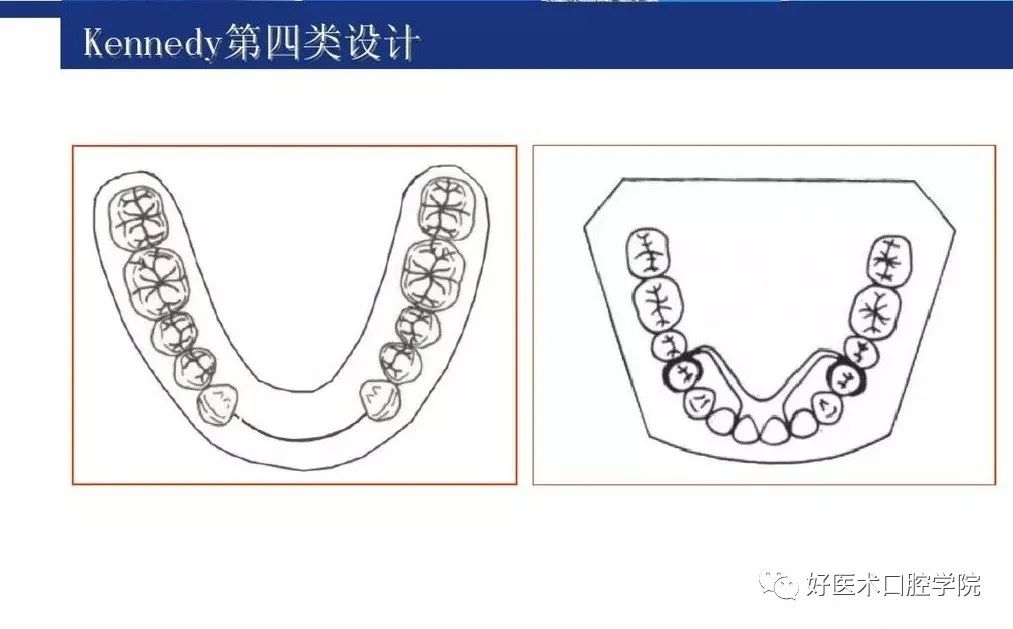 牙列缺损该如何设计修复，一文带你看懂！