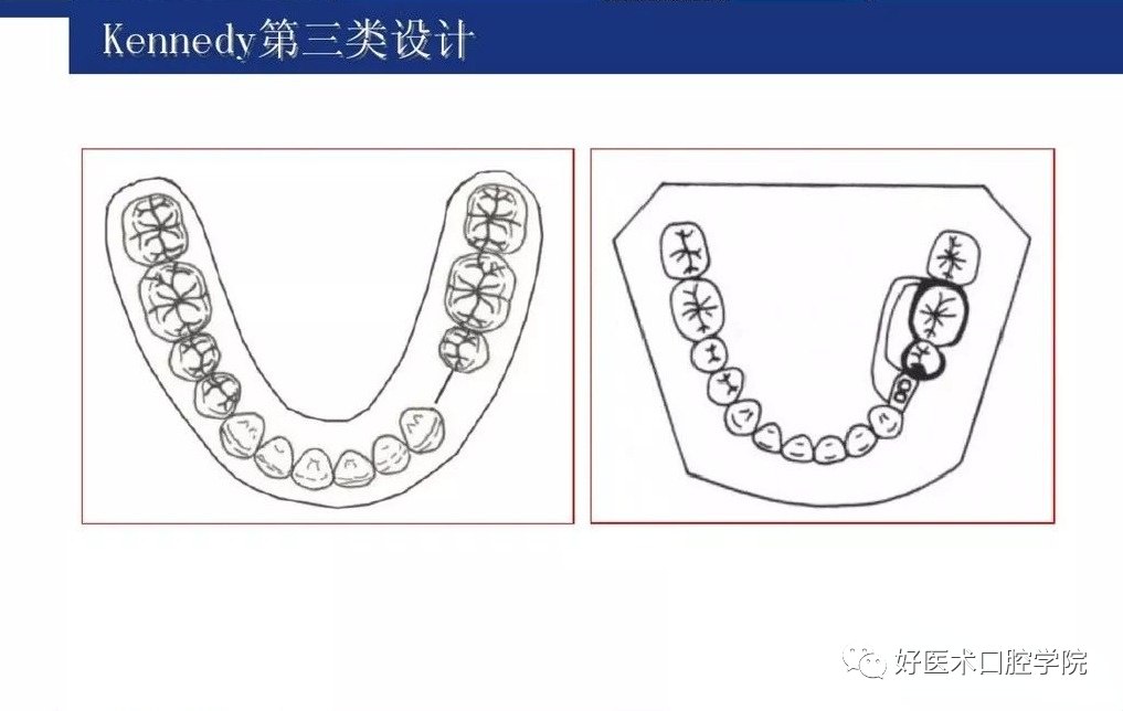 牙列缺损该如何设计修复，一文带你看懂！