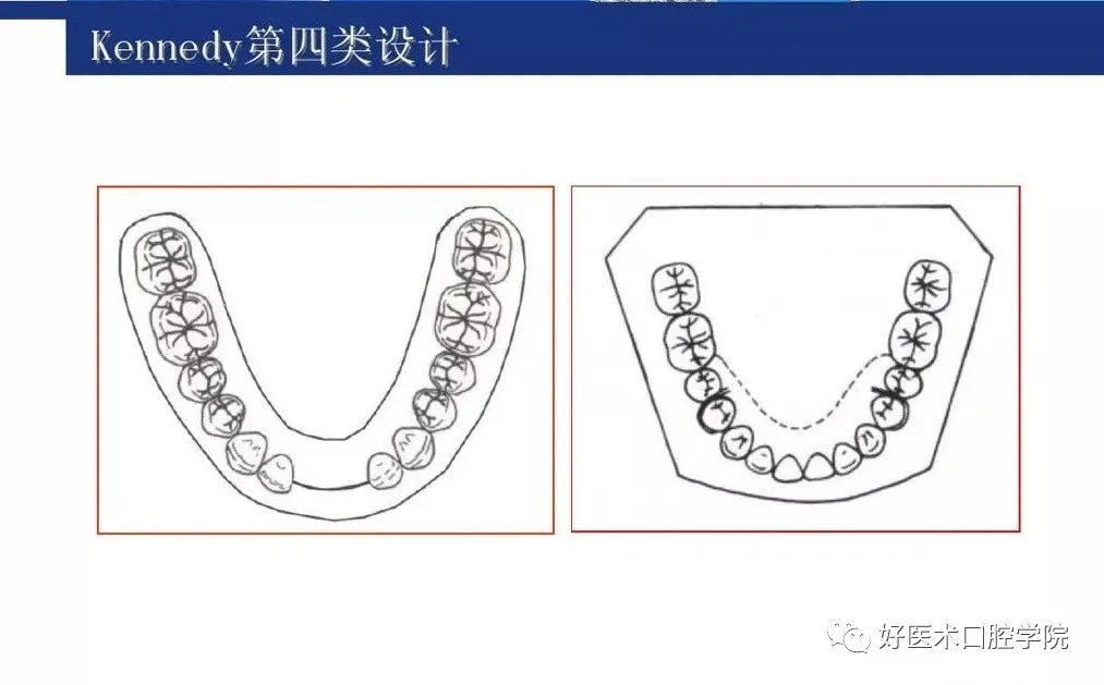 牙列缺损该如何设计修复，一文带你看懂！