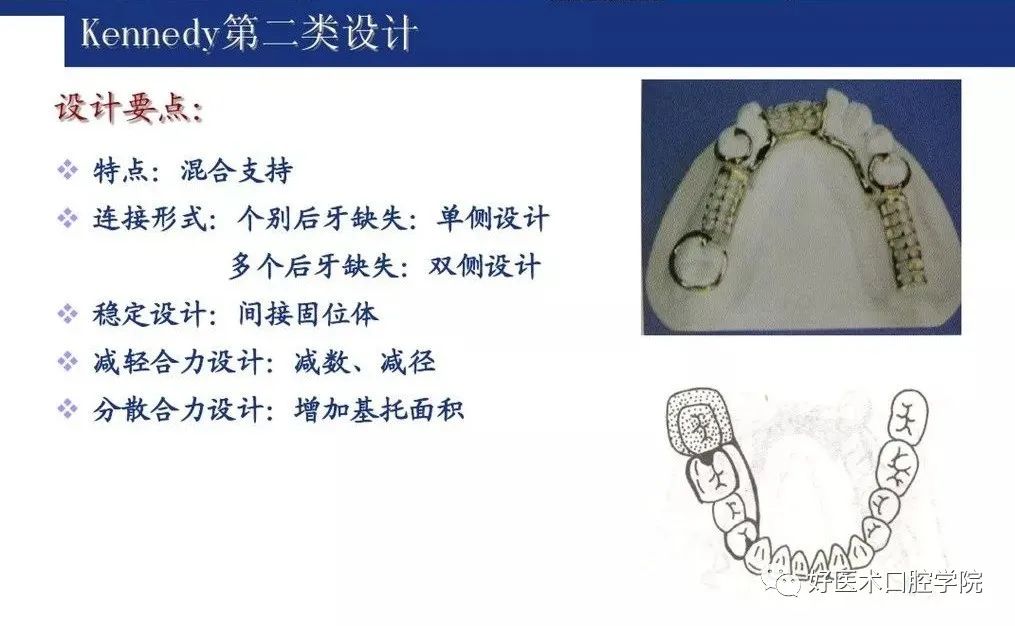 牙列缺损该如何设计修复，一文带你看懂！