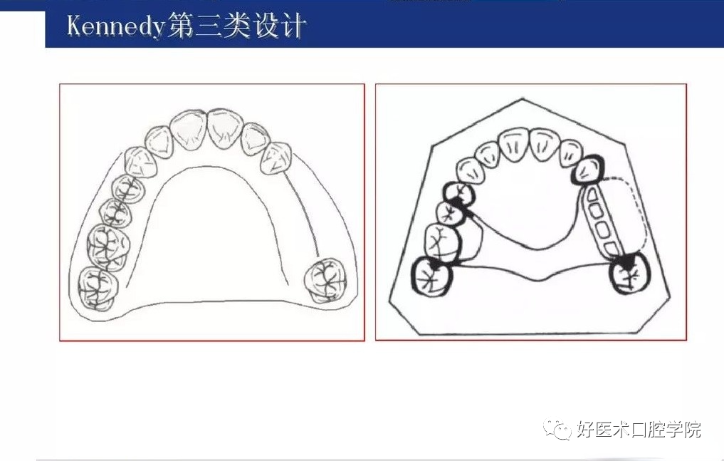 牙列缺损该如何设计修复，一文带你看懂！